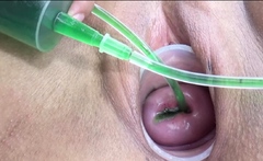 Cervix and Pee Hole Inflation with Injections for Japan Lesb